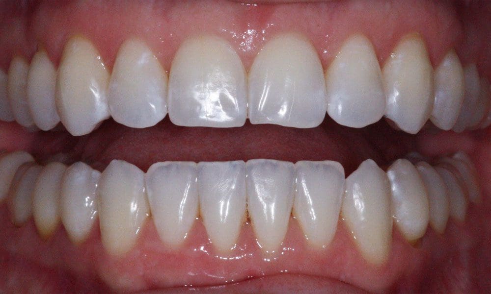 invisalign-case-17-after-image