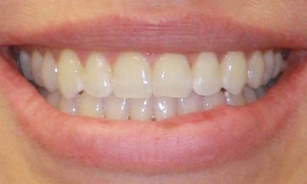 invisalign-case-17-before-image-2