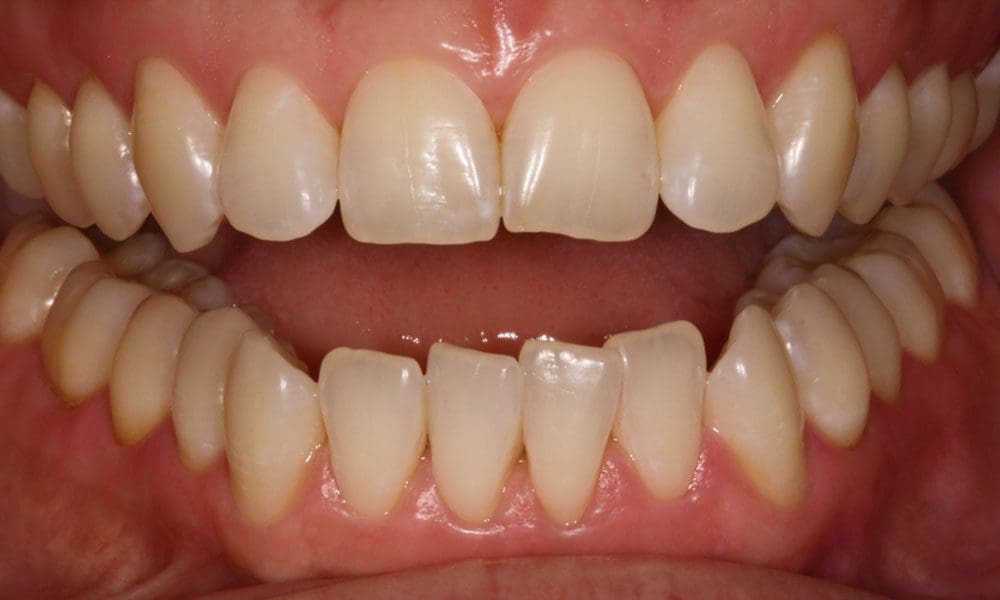 invisalign-case-17-before-image invisalign-case-17-before-image