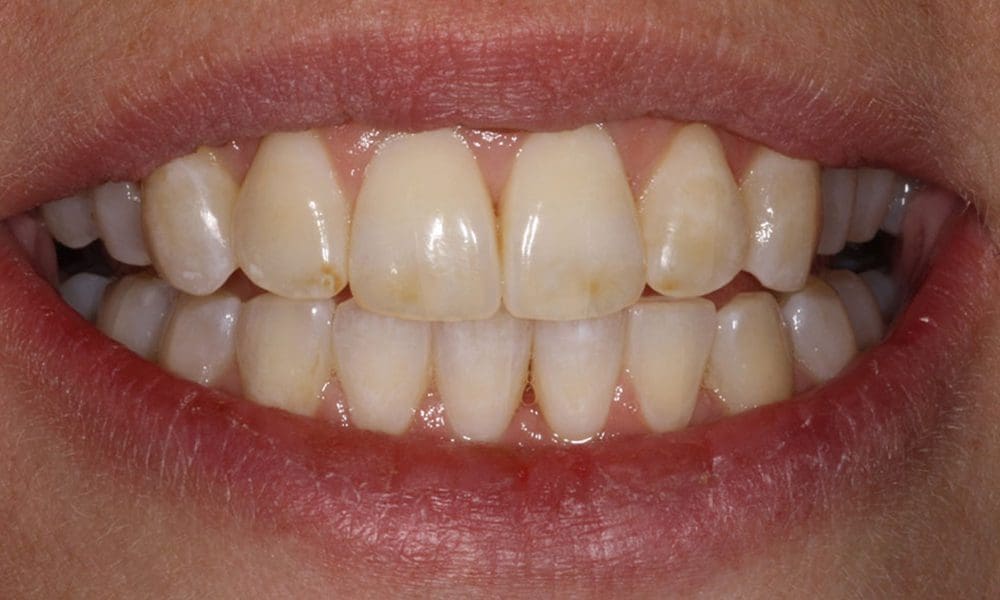 invisalign-case-18-after-image-2-new