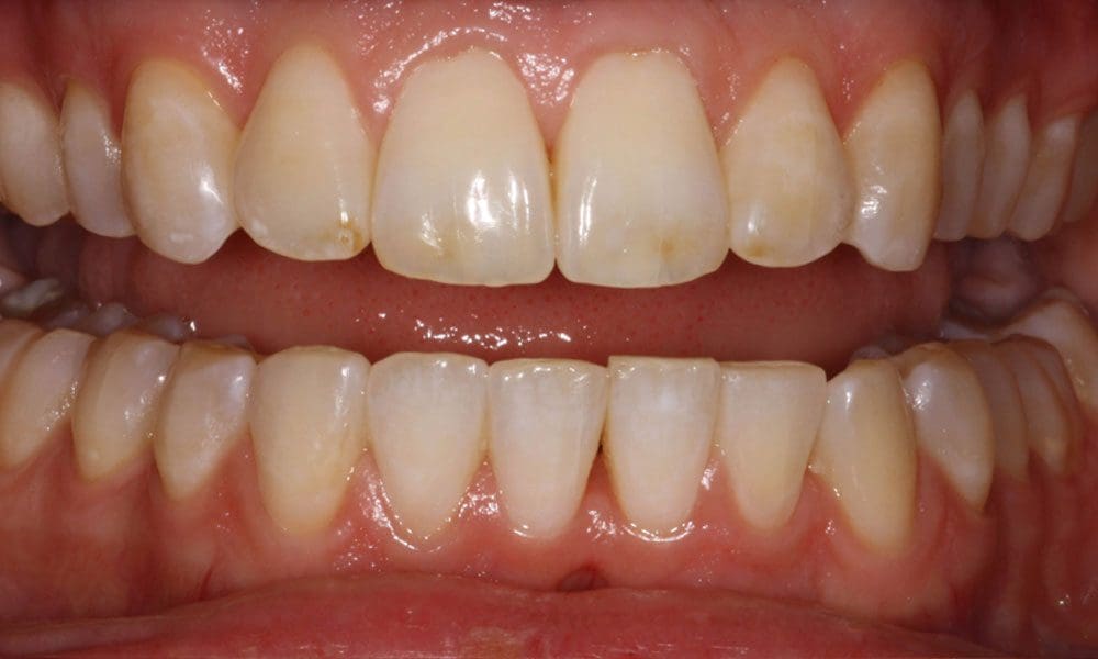 invisalign-case-18-after-image
