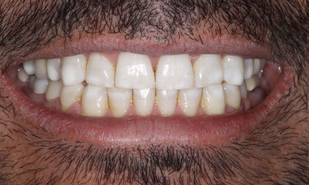 invisalign-case-19-after-image-2