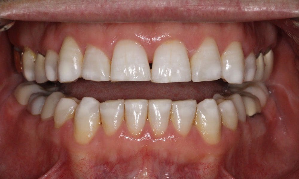 invisalign-case-19-after-image