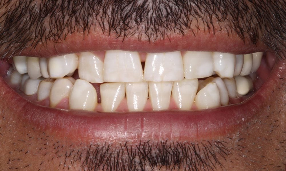 invisalign-case-19-before-image-2 invisalign-case-19-before-image-2