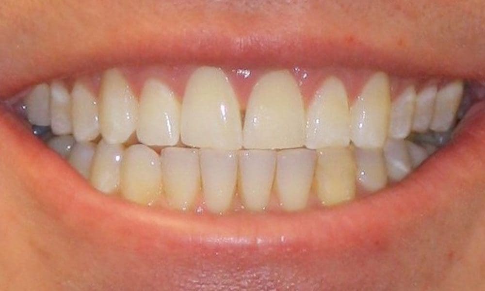 invisalign-case-20-after-image-2