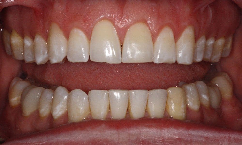 invisalign-case-20-after-image