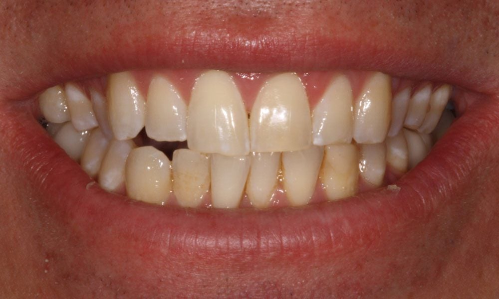 invisalign-case-20-before-image-2 invisalign-case-20-before-image-2