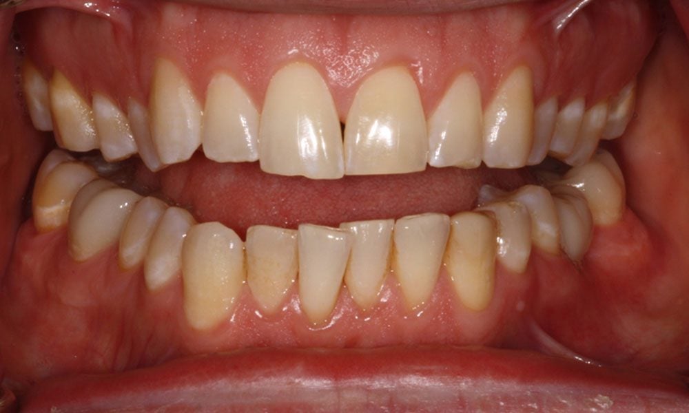 invisalign-case-20-before-image invisalign-case-20-before-image