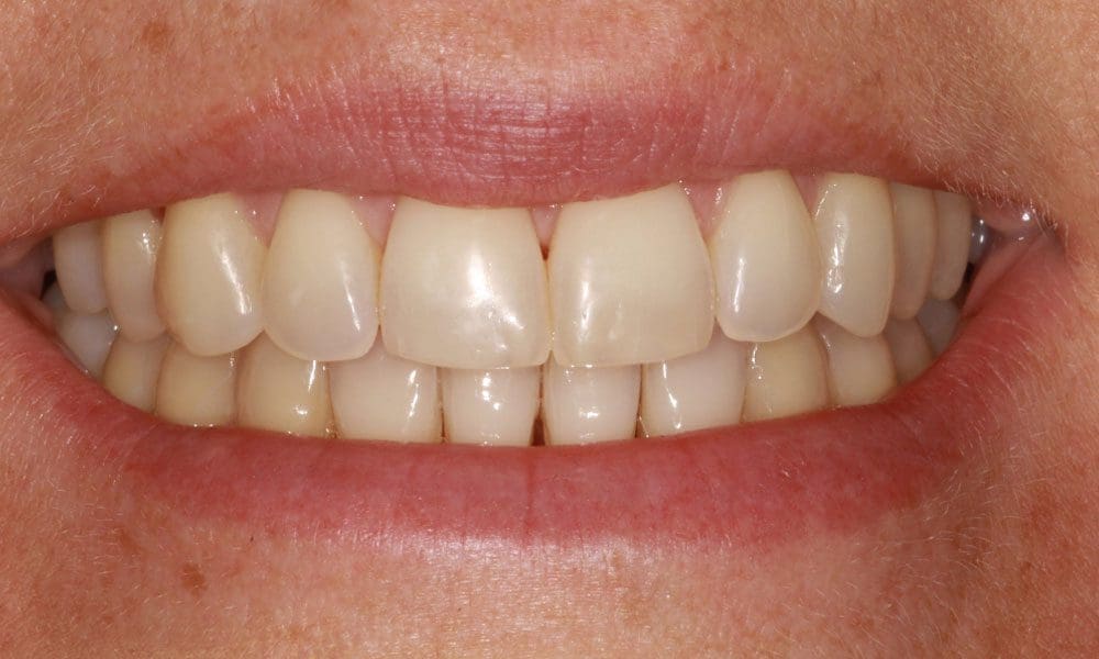 invisalign-case-21-after-image-2