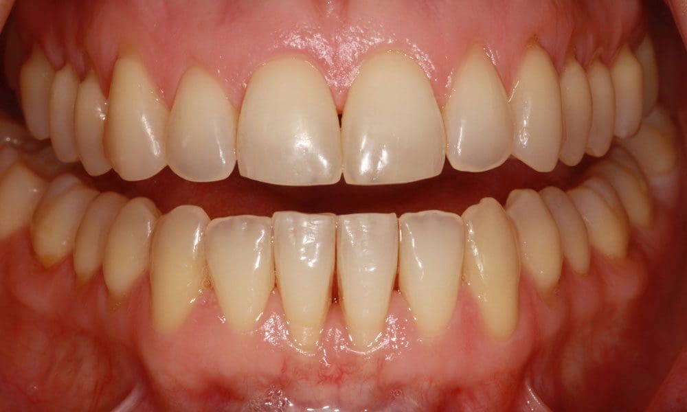 invisalign-case-21-after-image