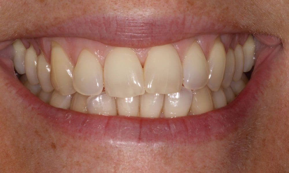 invisalign-case-21-before-image-2 invisalign-case-21-before-image-2