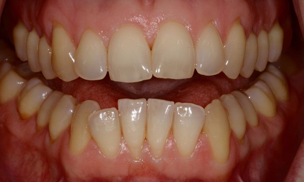 invisalign-case-21-before-image invisalign-case-21-before-image