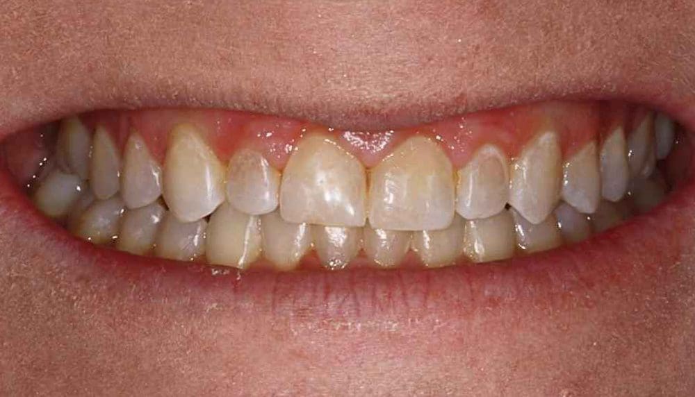 invisalign-case-24-before-image-1-new